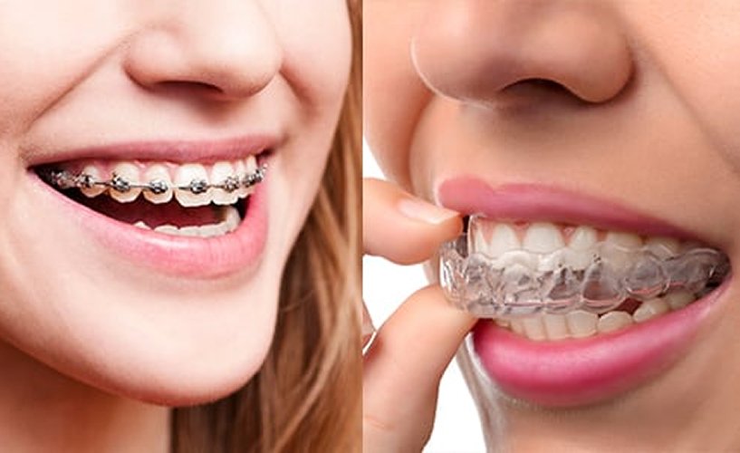 Braces And Aligners